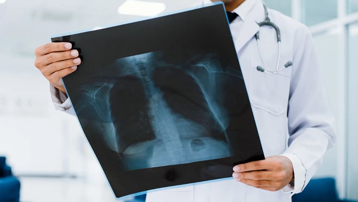 Chest Xray Cancer Risk Facts